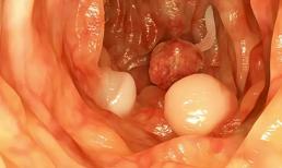 Tại sao lại bị polyp trong ruột? Có 7 lý do tại sao! 