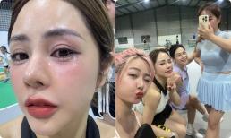 Vợ Huỳnh Anh gặp sự cố khiến mặt bị thương 