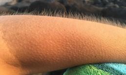 Tự dưng nổi da gà là điềm tốt hay xấu?