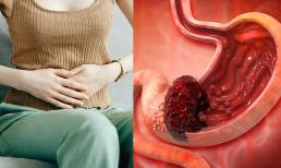 5 dấu hiệu tiền ung thư dạ dày. Việc xác định kịp thời có thể 'đánh bại' tình trạng bệnh nặng thêm