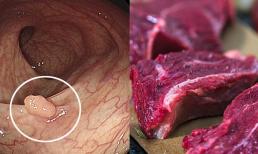 Nhắc lại lần nữa: Nếu không muốn polyp ruột biến thành ung thư ruột thì hãy cố gắng ăn ba thứ càng ít càng tốt
