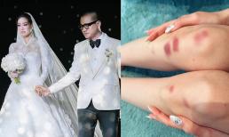 Hoa hậu Khánh Vân đăng ảnh đầu gối bầm dập sau đêm tân hôn, lý do là gì? 