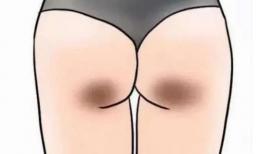 Tại sao con gái luôn có hai “vết đen” ở mông? Tiết lộ bí mật nhỏ của các cô gái 