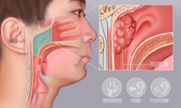Đừng nhầm lẫn ung thư với viêm mũi! Bác sĩ nhắc nhở: Khi ung thư vòm họng gõ cửa cơ thể sẽ đưa ra 4 “bí quyết” 