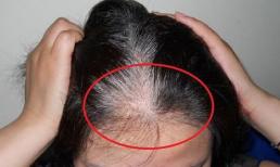 Tóc bạc mọc ở đâu, bệnh tật sẽ đến từ đó? Nếu mọc ở trán, thái dương, sau đầu thì có nghĩa là gì? 