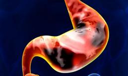 Nếu có ung thư dạ dày, cơ thể sẽ biết! Nếu cơ thể có 4 “bất thường” thì hãy nội soi dạ dày kịp thời 