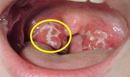 Cảnh báo: Khi thấy cơ thể có dấu hiệu này phải tới bệnh viện ngay kẻo ung thư vòm họng giai đoạn cuối