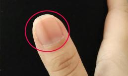 Tại sao lại có đường sọc thẳng đứng trên móng tay? Nếu có 4 bất thường ở móng tay, thì đó có thể là dấu hiệu của những vấn đề này 