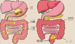 Khi đi vệ sinh, phân 'phía trước khô cứng, phía sau mềm dính' có nghĩa là gì?