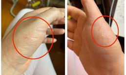 Vào mùa hè, tôi xuất hiện những mụn nước nhỏ. Có chuyện gì thế?