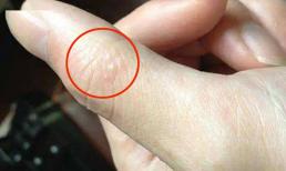 Những “đám mụn nước nhỏ” xuất hiện trên tay bạn vào mùa hè đang cảnh báo điều gì?