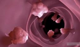 Hai loại polyp ruột, gần 80% chuyển thành ung thư! Bốn triệu chứng khi đi vệ sinh báo hiệu polyp sắp xuất hiện