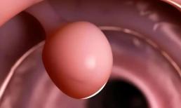 Polyp ruột của người đàn ông 68 tuổi đã biến mất. Phương pháp ông sử dụng để làm sạch ruột thật đáng để học hỏi!