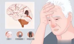 Dấu hiệu cho thấy bạn từng bị đột quỵ mà không biết! Đừng vội bỏ qua