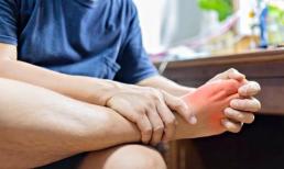 Hai dấu hiệu điển hình để phân biệt bệnh Chikungunia với sốt xuất huyết, tránh nhầm lẫn