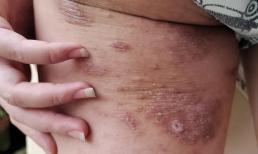 Các bác sĩ cảnh báo: Ngứa ở 4 vùng này trên cơ thể có thể là dấu hiệu của HIV! Hãy đi khám ngay lập tức