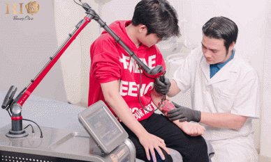 Xóa hình xăm ở đâu uy tín và không để lại sẹo?