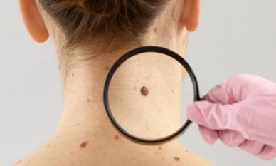 '3 đen' xuất hiện trên cơ thể cảnh báo ung thư cận kề, không được chủ quan trước khi quá muộn!