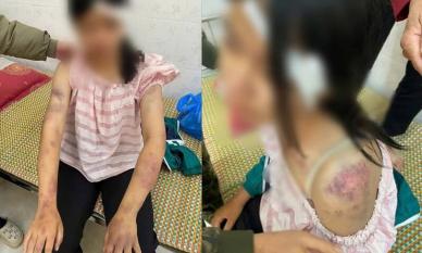 Vụ bé gái 13 tuổi bị bạo hành: Hé lộ kết quả giám định thương tích, 3 người thân bị khởi tố
