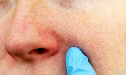 Da gặp 3 tình trạng này có thể dẫn đến lỗ chân lông to!