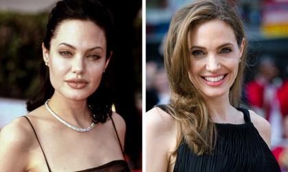 10 người nổi tiếng thay đổi hoàn toàn nhờ 'phép thuật' của phẫu thuật thẩm mỹ 