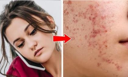 Thói quen nào khiến 8 vùng cơ thể này nổi mụn?