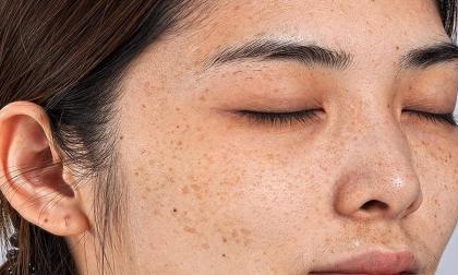 Không muốn trở thành “cô gái vàng mặt”, những cô nàng bị tàn nhang hãy ăn thêm 3 loại thực phẩm giúp làm mờ tàn nhang