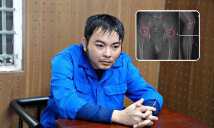 Tự đục xương, giả vờ bị tai nạn để trục lợi bảo hiểm hơn 6 tỷ đồng, cựu cán bộ y tế và đồng phạm đối mặt mức án nào?