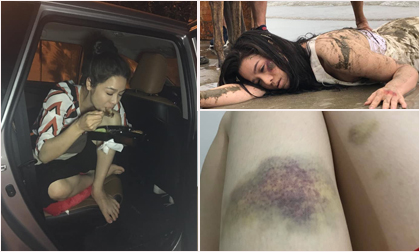 Xót xa khi nhìn cảnh Nhật Kim Anh 'ăn bờ ngủ bụi', người ngợm trầy trật thâm tím