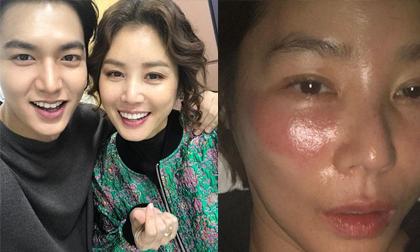 'Mẹ Lee Min Ho' Kim Sung Ryung mặt sưng vù do sai lầm đơn giản khi đắp mặt nạ