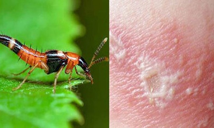 Kiến ba khoang tấn công, độc tố mạnh gấp 12-15 lần rắn hổ mang: Đây là cách xử lý đúng nhất bác sĩ khuyên làm