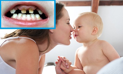 Hôn trẻ thường xuyên khiến con bị sâu răng và phương pháp phòng ngừa sâu răng đúng cách