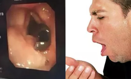 Ho 2 tháng không khỏi, hóa ra có 2 con đỉa sống trong cổ họng