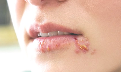 Cách giúp bạn tránh những vết loét, mụn nước mọc trên môi