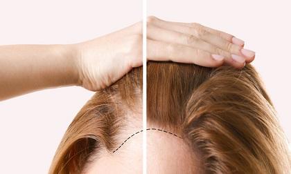 Những mẹo hô biến mái tóc mỏng tang thưa thớt trở nên dày hơn trông thấy