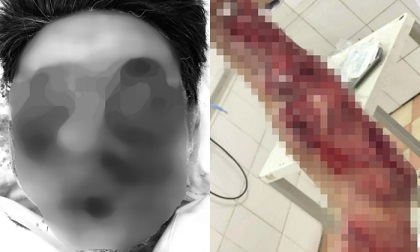 Chơi pháo tự chế ngày cận Tết, người đàn ông bị dập nát khuôn mặt và cánh tay