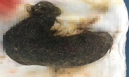 Nghiện ăn tóc từ năm 2 tuổi, bé gái ở Hà Nội có khối u lớn dài 20cm trong dạ dày