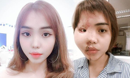 Cô gái bị chồng sắp cưới tạt axit biến dạng khuôn mặt: Sau 1 năm đã trở lại với nụ cười xinh đẹp rạng rỡ