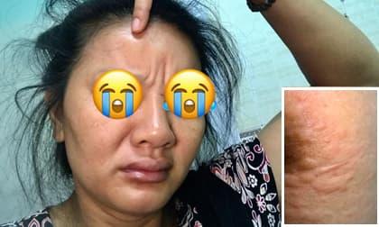 Bị dị ứng bạch tuộc, diễn viên Kiều Trinh chia sẻ cách chữa tại nhà