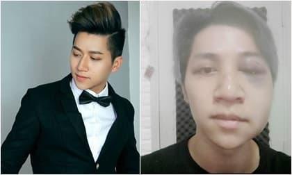 Á quân 'Nhân tố bí ẩn' gặp tai nạn giao thông nghiêm trọng bị chấn thương não, liệt nửa mặt 