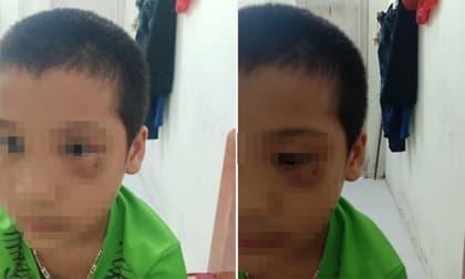 Vụ phụ huynh tát trẻ mẫu giáo: Người mẹ chính thức xin lỗi, công khai luôn ảnh đôi mắt bầm tím của con mình