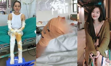 Cô giáo mầm non hồi phục thần kỳ sau 4 năm gặp nạn đúng ngày khai trường do bình bơm bóng phát nổ