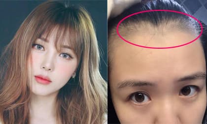 5 thói quen xấu khiến ngôi tóc to và đường chân tóc mọc về phía sau như hói, thậm chí rụng tóc liên tục