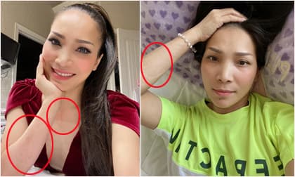 Nhan sắc phục hồi sau trận bỏng, Hồng Ngọc lần đầu để lộ thương tích khó lành ở tay và ngực