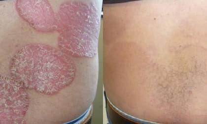 Kiểm soát hiệu quả bệnh vẩy nến bằng kết hợp thảo dược