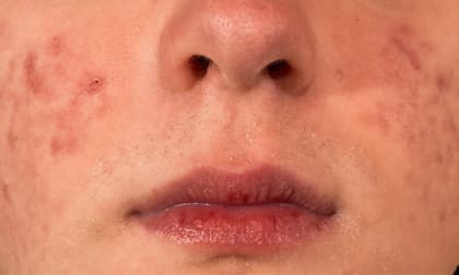 Ba thói quen là “đồng bọn của mụn” sẽ tạo điều kiện cho mụn mọc nhiều lần và nên tránh xa càng sớm càng tốt