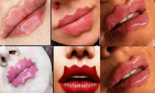 Trào lưu tiêm filler để tạo dáng môi 'chẳng giống ai' của hội chị em: Độc đáo hay kinh dị?