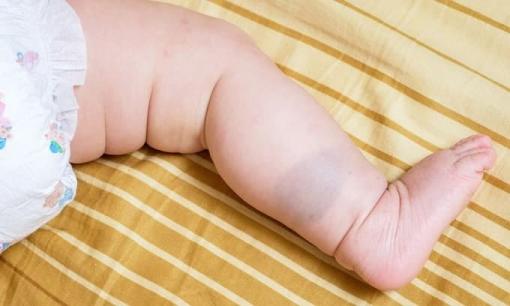 Em bé sở hữu vết bớt sẽ có chỉ số IQ cao hơn những đứa trẻ bình thường khác?