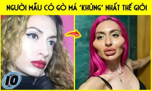 4 năm tiêm filler nhưng 'người mẫu có gò má bự nhất thế giới' vẫn chưa thỏa mãn: 'Tôi thấy vẫn còn nhỏ lắm, phải tiêm thêm'