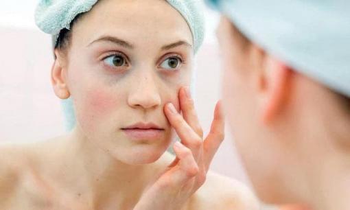 Chuyên gia da liễu lưu ý cách chăm sóc da sau khi trị nám bằng Laser